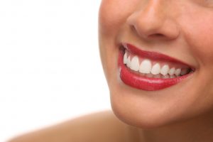 dental veneers 