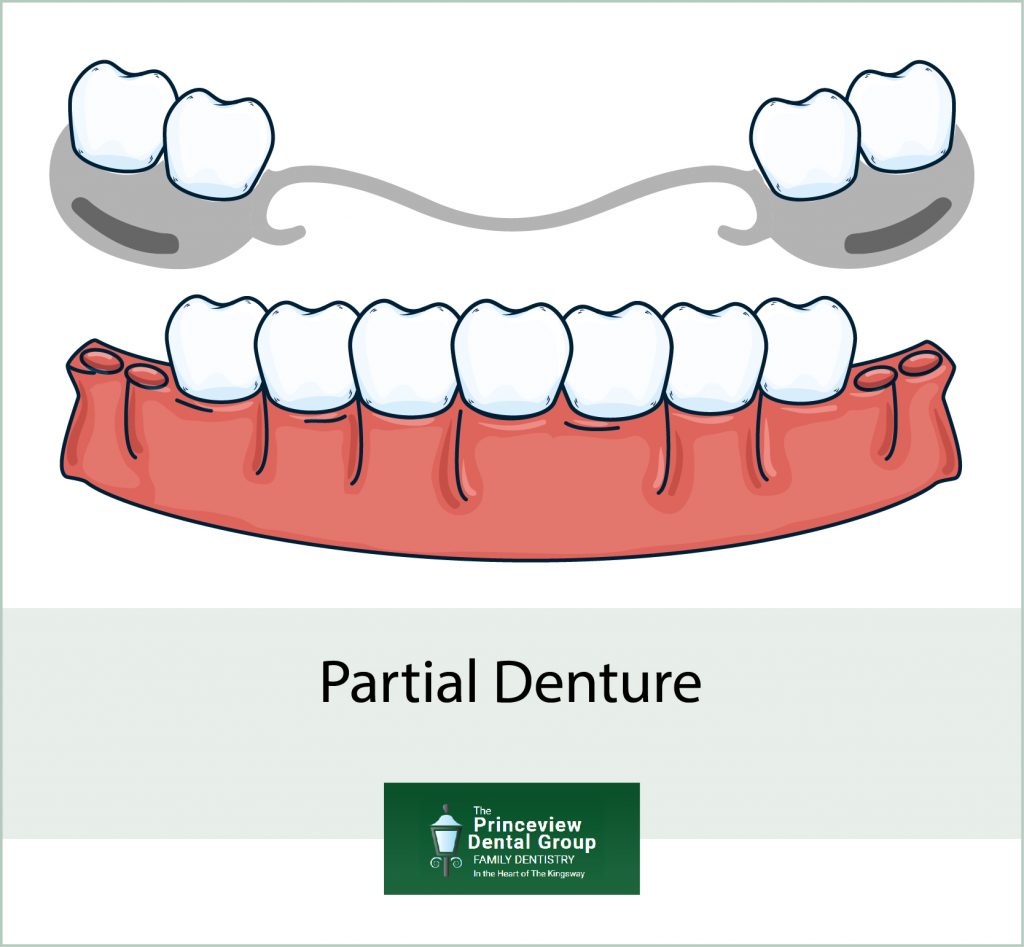 Partial Dentures