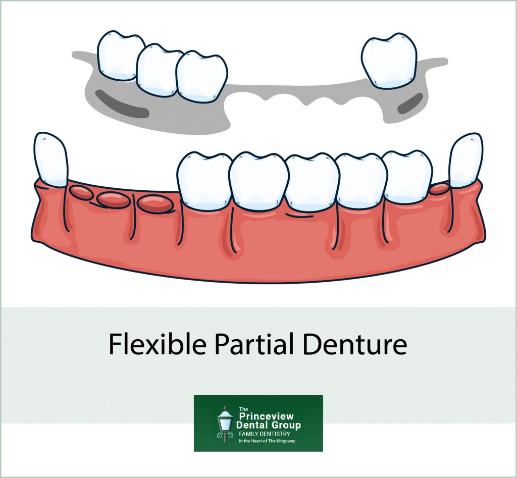 Flexible Partial Dentures