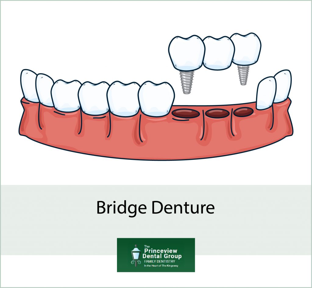 Fixed Dentures and Dental Bridges