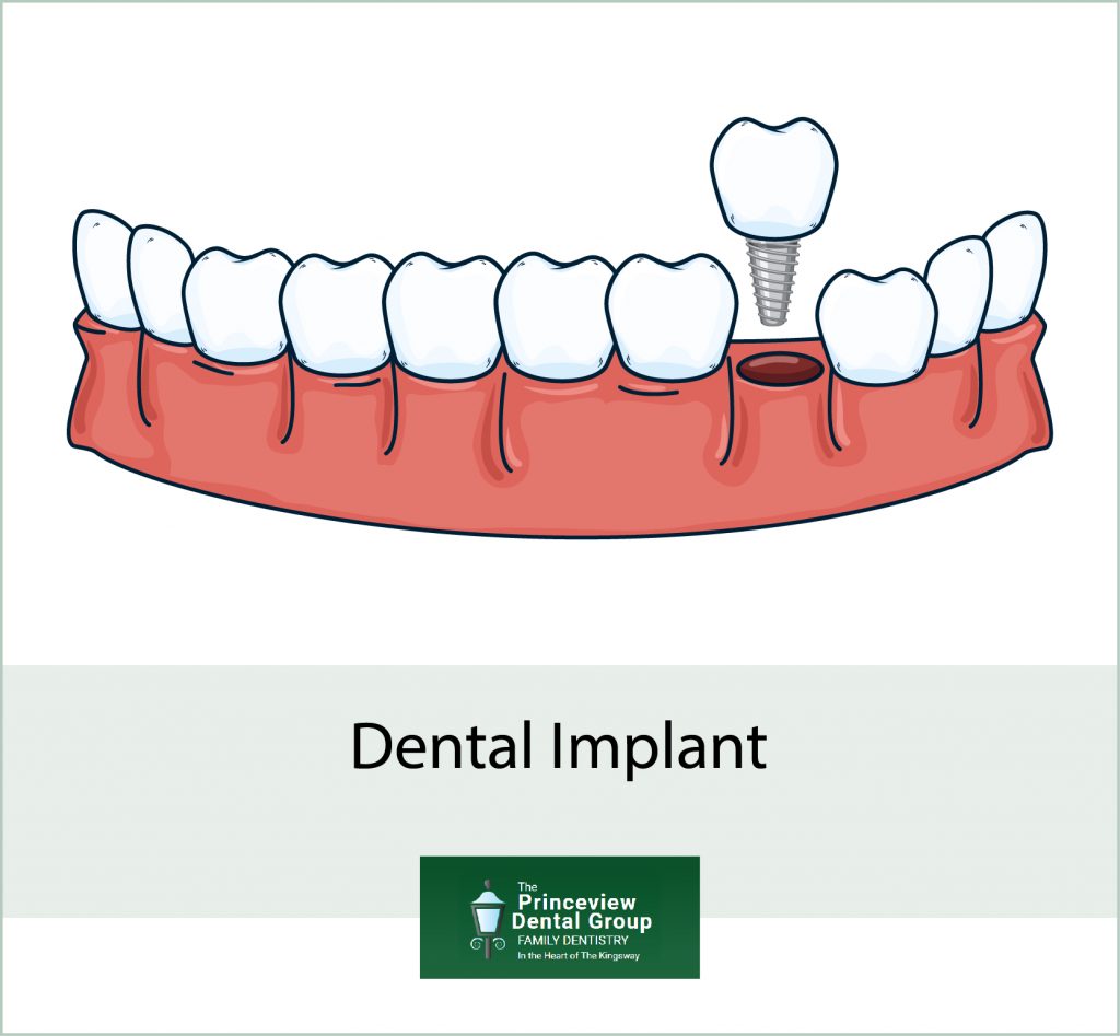 Dental Implant