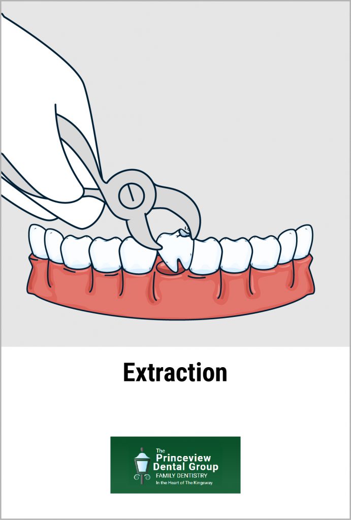 Tooth Extraction
